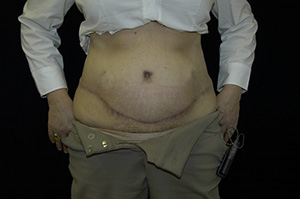 Abdominoplasty 4b